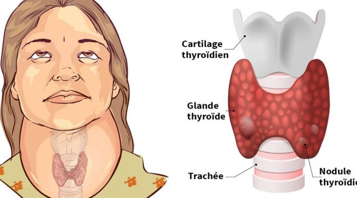 5 Signes Qui Peuvent Reveler Un Dereglement De La Thyroide