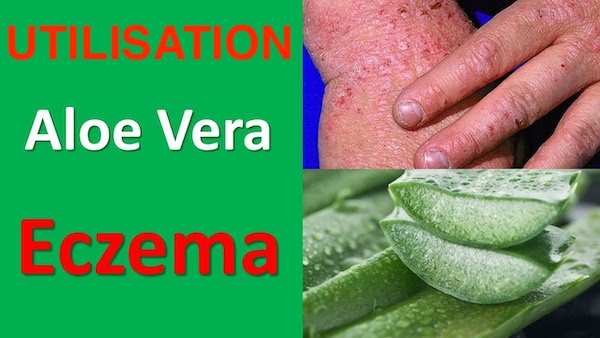 Segíthet az aloe vera a fejbőr pikkelysömörében | Sanidex Magyarországon